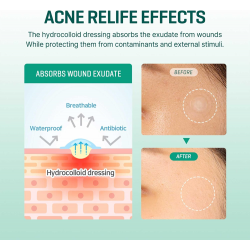 لاصقة علاج حب الشباب تركيبة 30 يوم السحرية سوم باي مي 18 لاصقة Acne Treatment Patch Some By Mi Magical 30 Day Formula